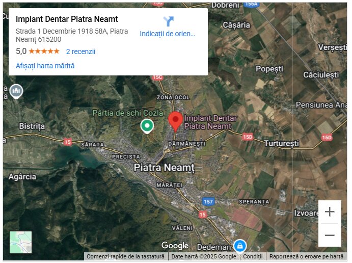 Implant Dentar Piatra Neamt