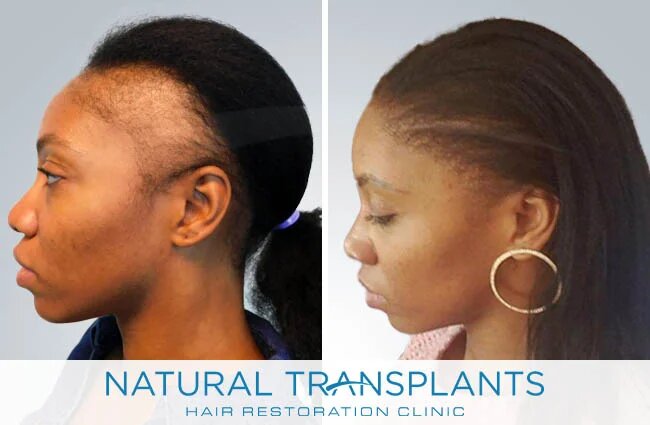 Natural Transplants
