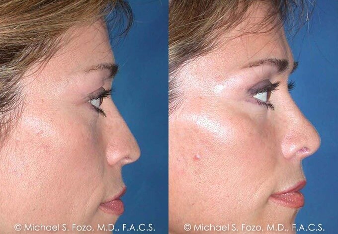 Lakeshore Facial Plastic Surgery Expands Advanced Eyelid Surgery Services in Michigan