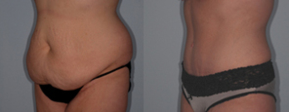 Real, Un-Photoshopped Tummy Tuck at Southern Surgical Arts