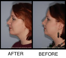 chin implant