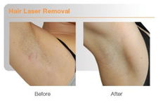 permanent hair reduction