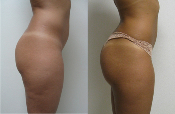 A Brazilian Butt Lift patient (fat transfer to her buttock)