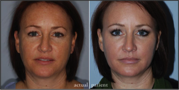 Lip augmentations from Southern Surgical Arts 