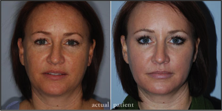 Lip augmentations from Southern Surgical Arts