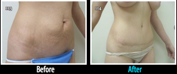 Dr. Lane Smith’s Tummy Tucks Offer Permanent Solutions to Enhance Your Figure