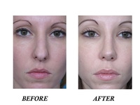 Rhinoplasty Boca Raton