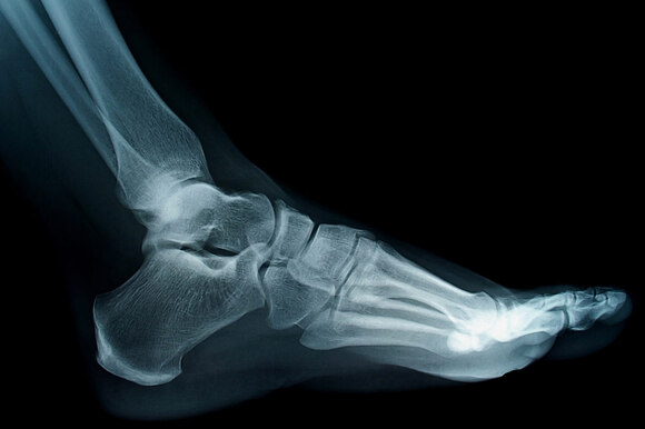 Lifetime Issues: Midfoot Fracture-Dislocations and Metatarsal Fractures 