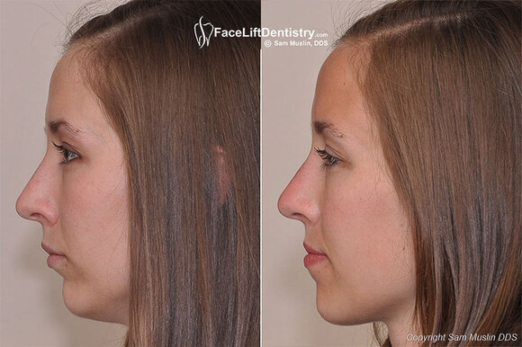 Repositioning the Jaw and Correcting a Small Chin without Surgery