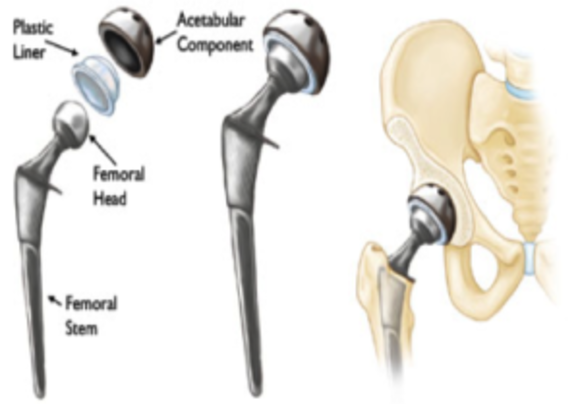 Zimmer Kinectiv Hip Implant Trial Ends In $2 Mil. Verdict For Injured ...