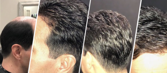How PHD Dallas Hair Replacement Is Helping Men with Non-Surgical Hair Replacement