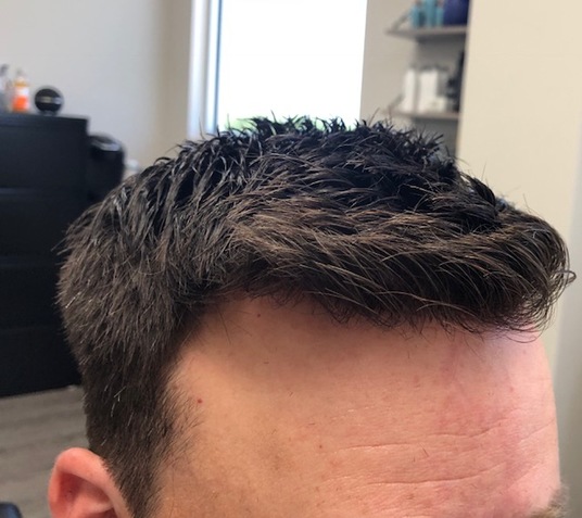 The Demographics of Men Having Non Surgical Hair Replacement are Changing