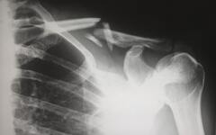 The Two Most Frequent Personal Injury Claims - Hull and Zimmerman P.C.