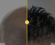 In this picture we show a young male from bald to having hair back using folicure solution for balding men of any age.