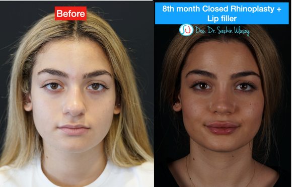 All you need to know about Rhinoplasty in Turkey – M.D. Seçkin Ulusoy