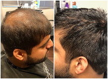 Future of Hair Replacement in 2021 - Folicure Hair Report