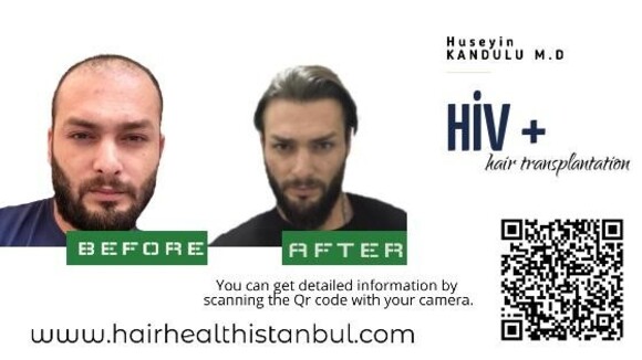 HIV Hair Transplant – Hair Health Istanbul – Dr. Kandulu