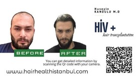 HIV Hair Transplant – Hair Health Istanbul – Dr. Kandulu