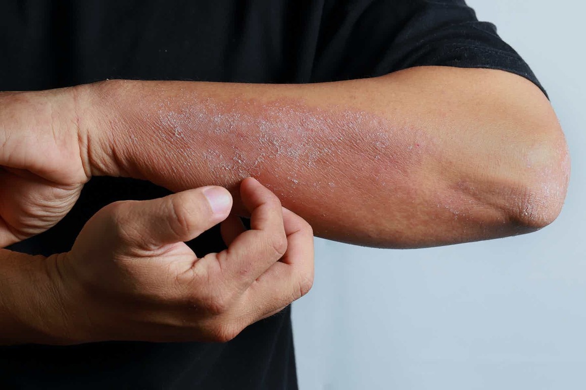Top dermatology experts from across the world unite to call for comprehensive action to elevating skin disease.