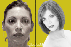 What Is the Process of Folicure Hair Restoration for Women