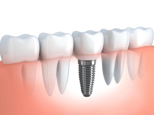 King Dental: David King, DMD Specializes in Dental Implants in Huntsville