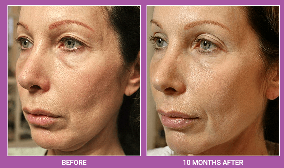 B.A.R.E. Introduces Thermage RF System for Non-Invasive Anti-Aging Treatments