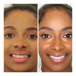 Cosmetic Dentistry Center NYC Shares Dental Crisis with Ozempic Teeth