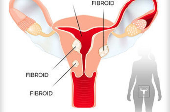 Ascend Pain &amp; Wellness  Expands Uterine Fibroid Embolization Services At Woodridge Clinic