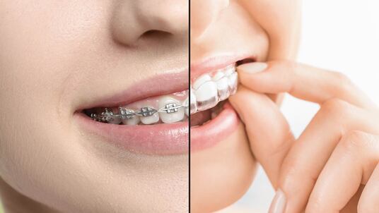 Zenyum Singapore Offers Flexible Payment Options On Clear Aligners in 2026