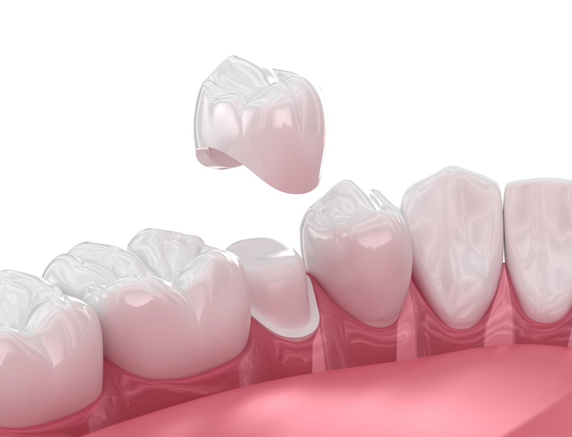 same day dental crowns
