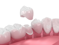 same day dental crowns