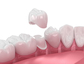same day dental crowns