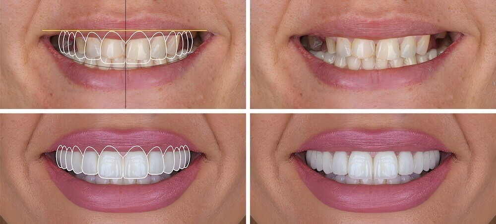 Des Moines Cosmetic Dentistry Center Introduces New Patient Guide to Comparing Cosmetic Dental Treatment Costs