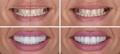 Des Moines Cosmetic Dentistry Center Introduces New Patient Guide to Comparing Cosmetic Dental Treatment Costs